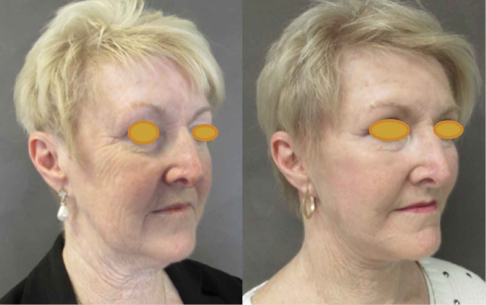 face-neck lift-before-after